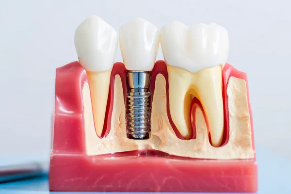 Lorton dental services - Dental Implants