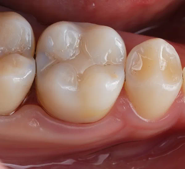 What are dental fillings