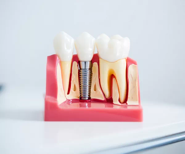 what are dental implants