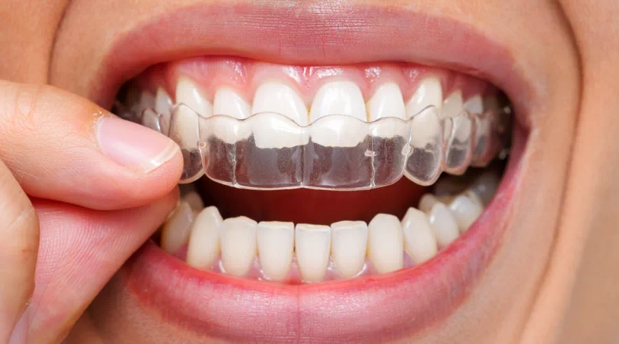 investing in Invisalign
