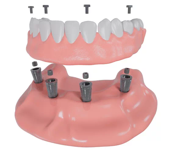 what are All-on-4 Dental Implants