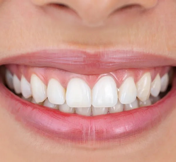 appeal of dental bonding