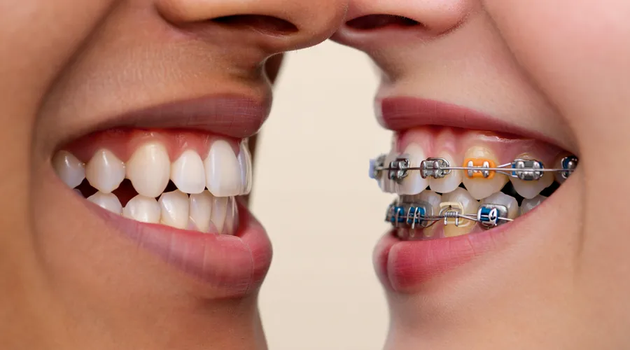 Types of Braces