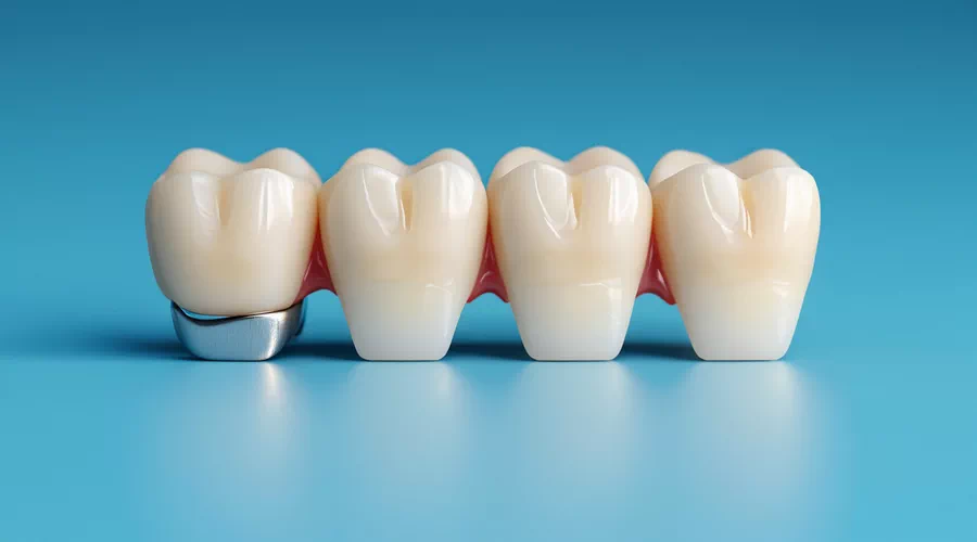 How does a dental bridge work