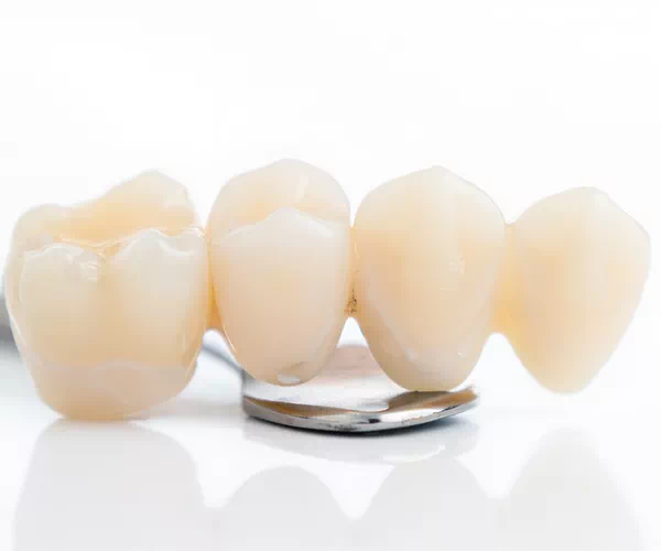 What are Dental Bridges in Lorton VA