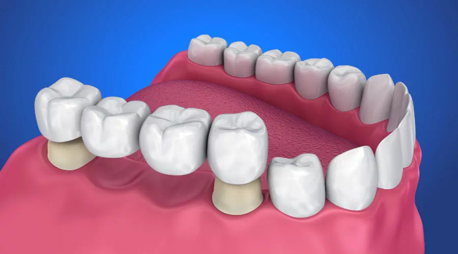 different types of dental bridges