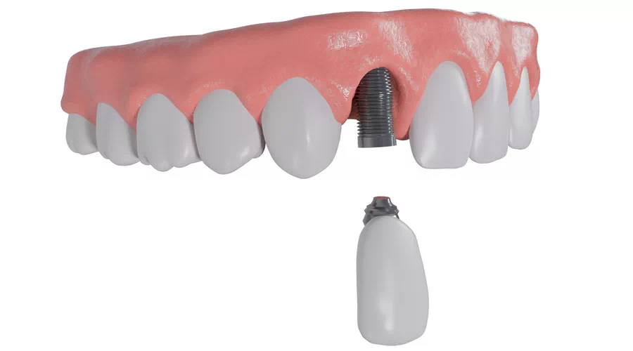 implant-supported