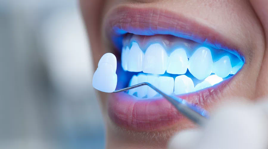 install dental veneers