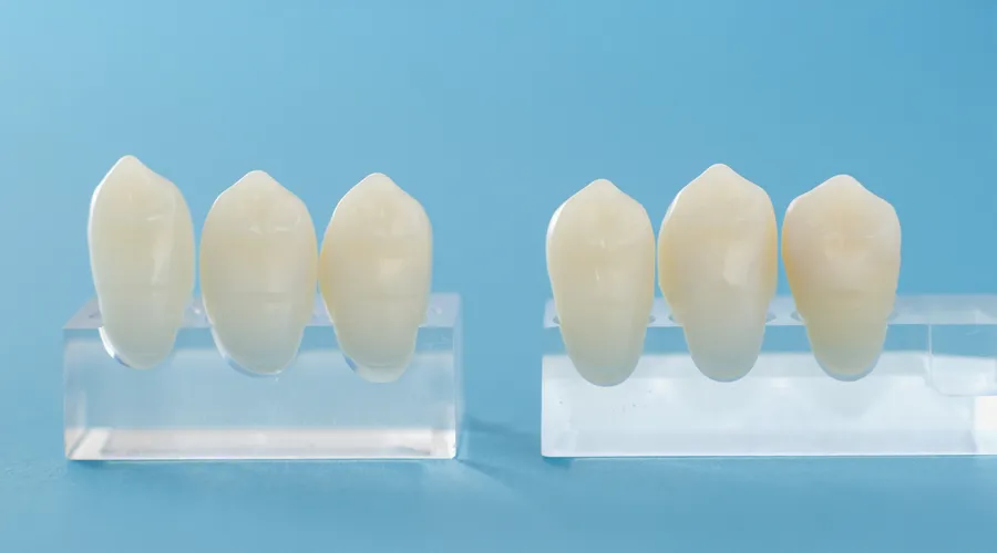 What determines the cost of porcelain veneers